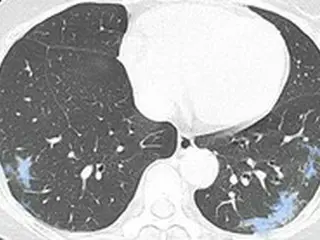 「コロナによる肺・胸部疾患の研究、医療AIを活用する」＝韓国